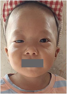 Noonan syndrome caused by RIT1 gene mutation: A case report and literature review